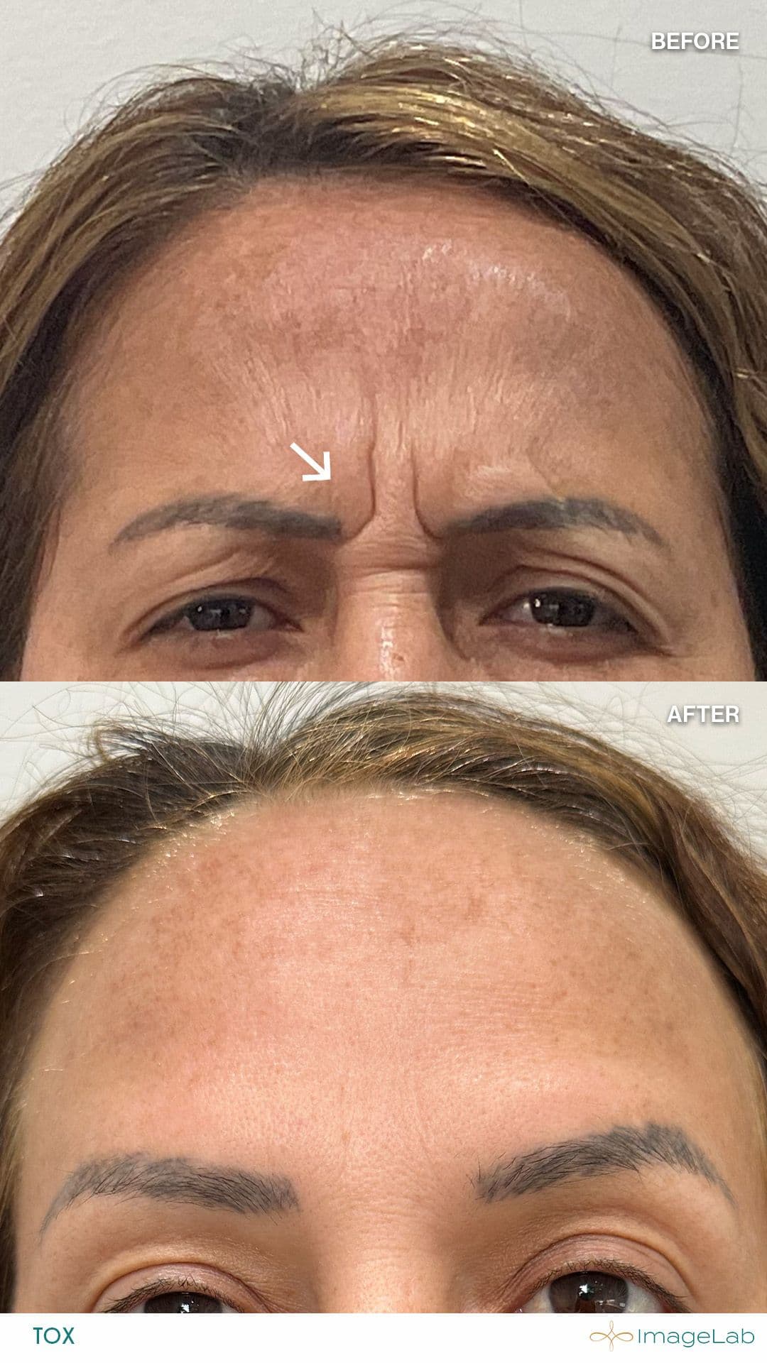 Before and after result