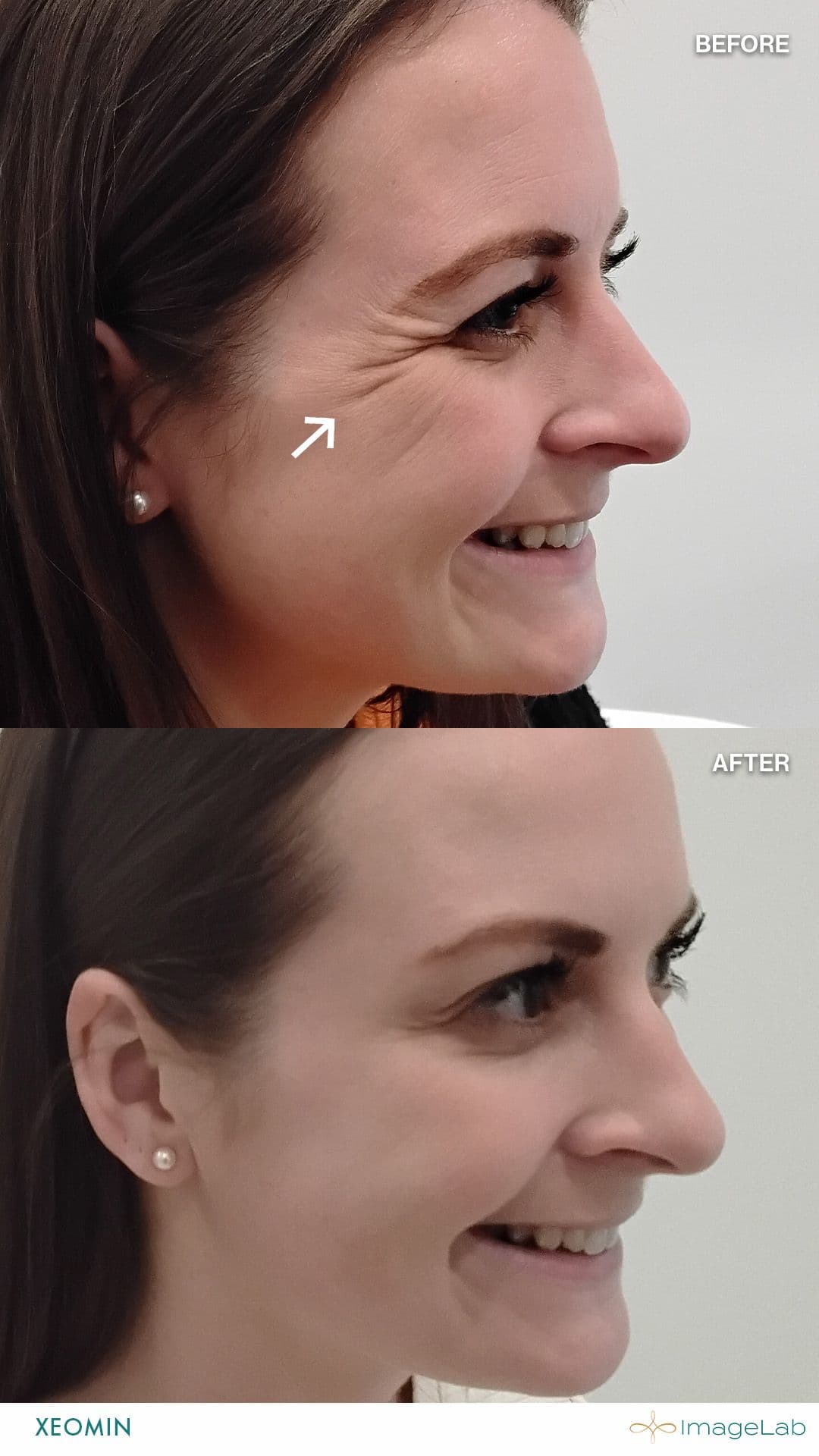 Before and after result