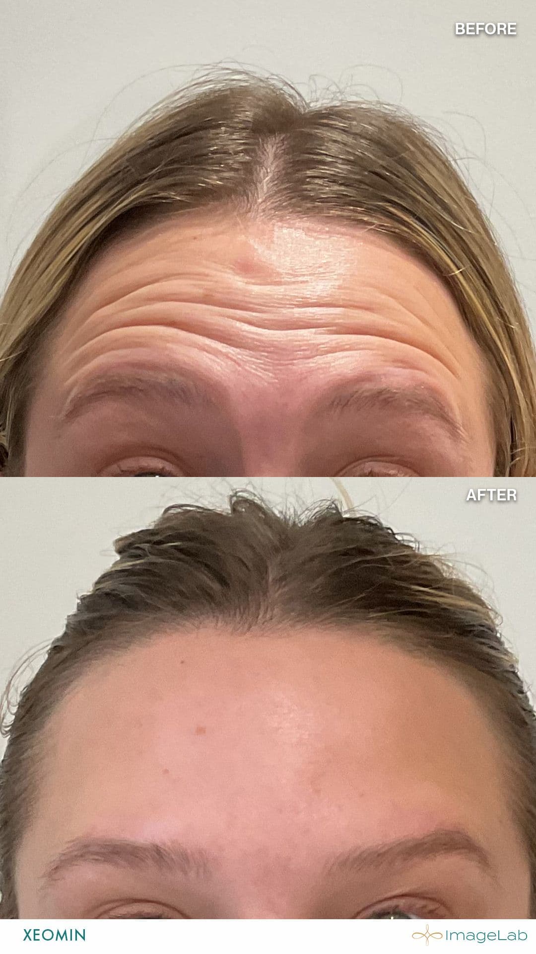 Before and after result