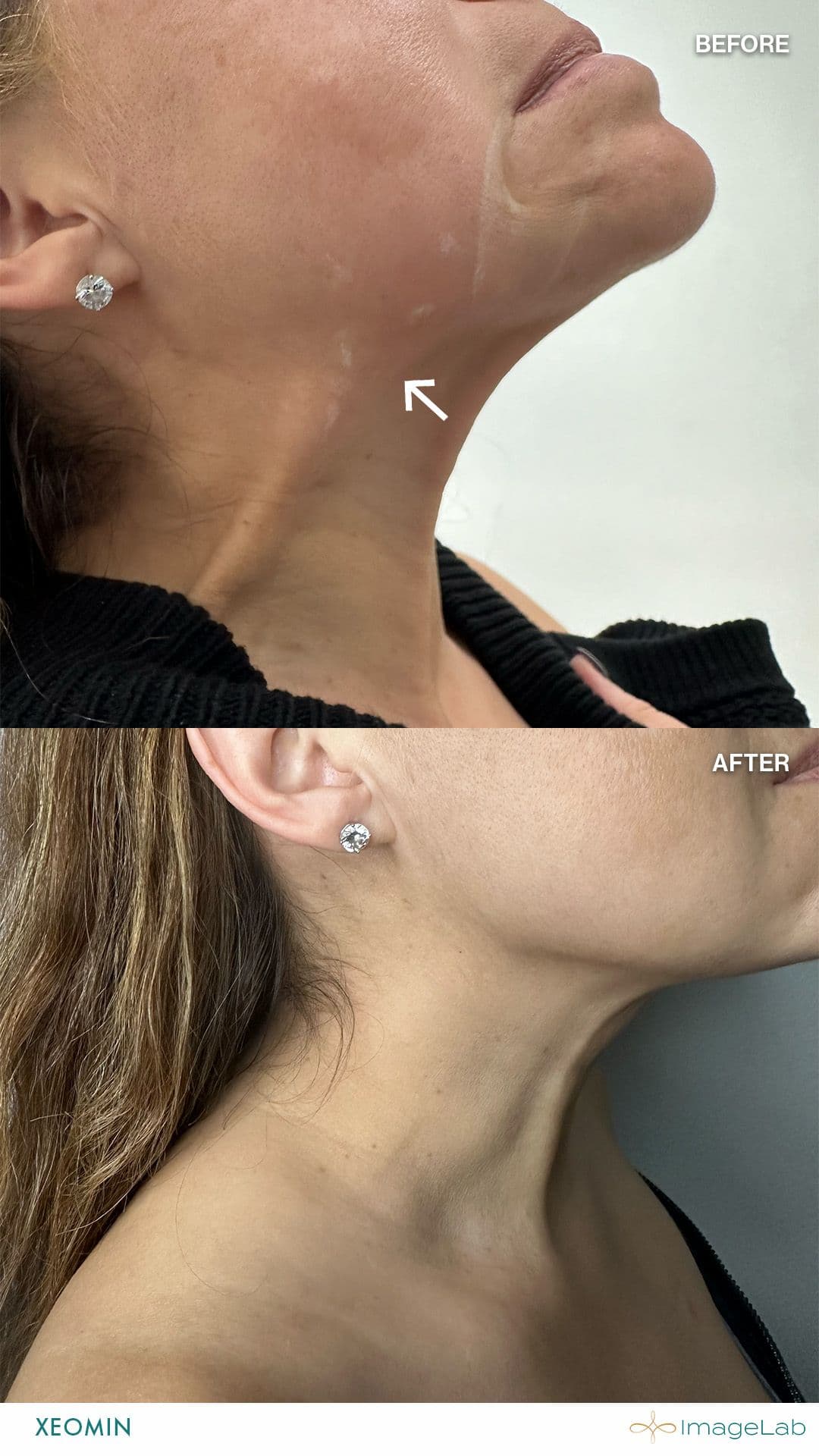 Before and after result