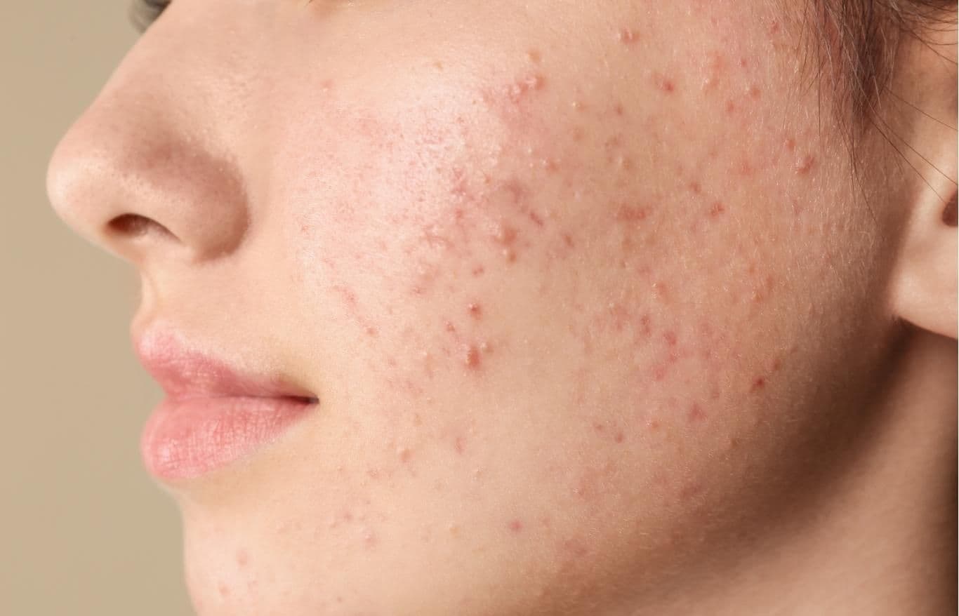 chemical peels treatment