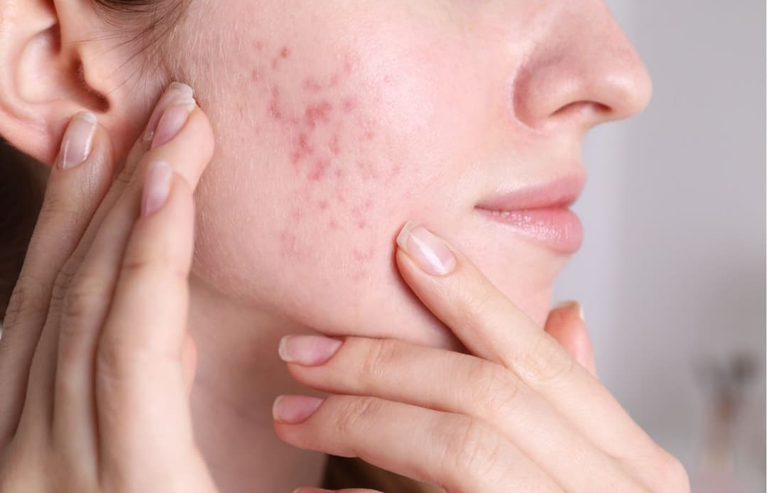 PRP for Acne Scarring