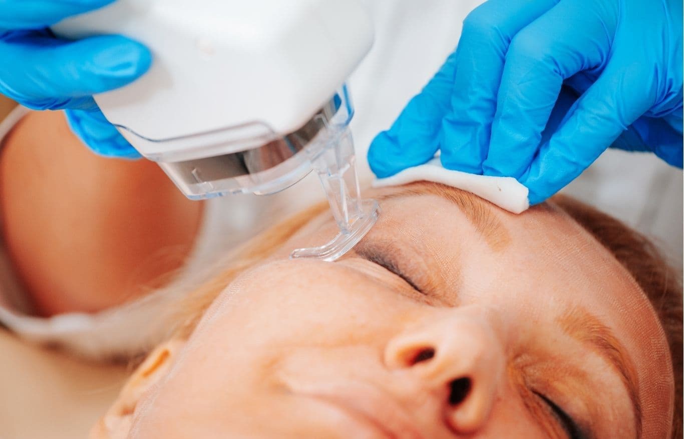 laser skin resurfacing treatment