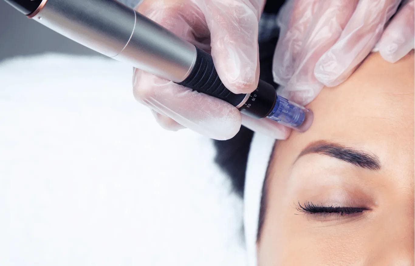 woman getting microneedling