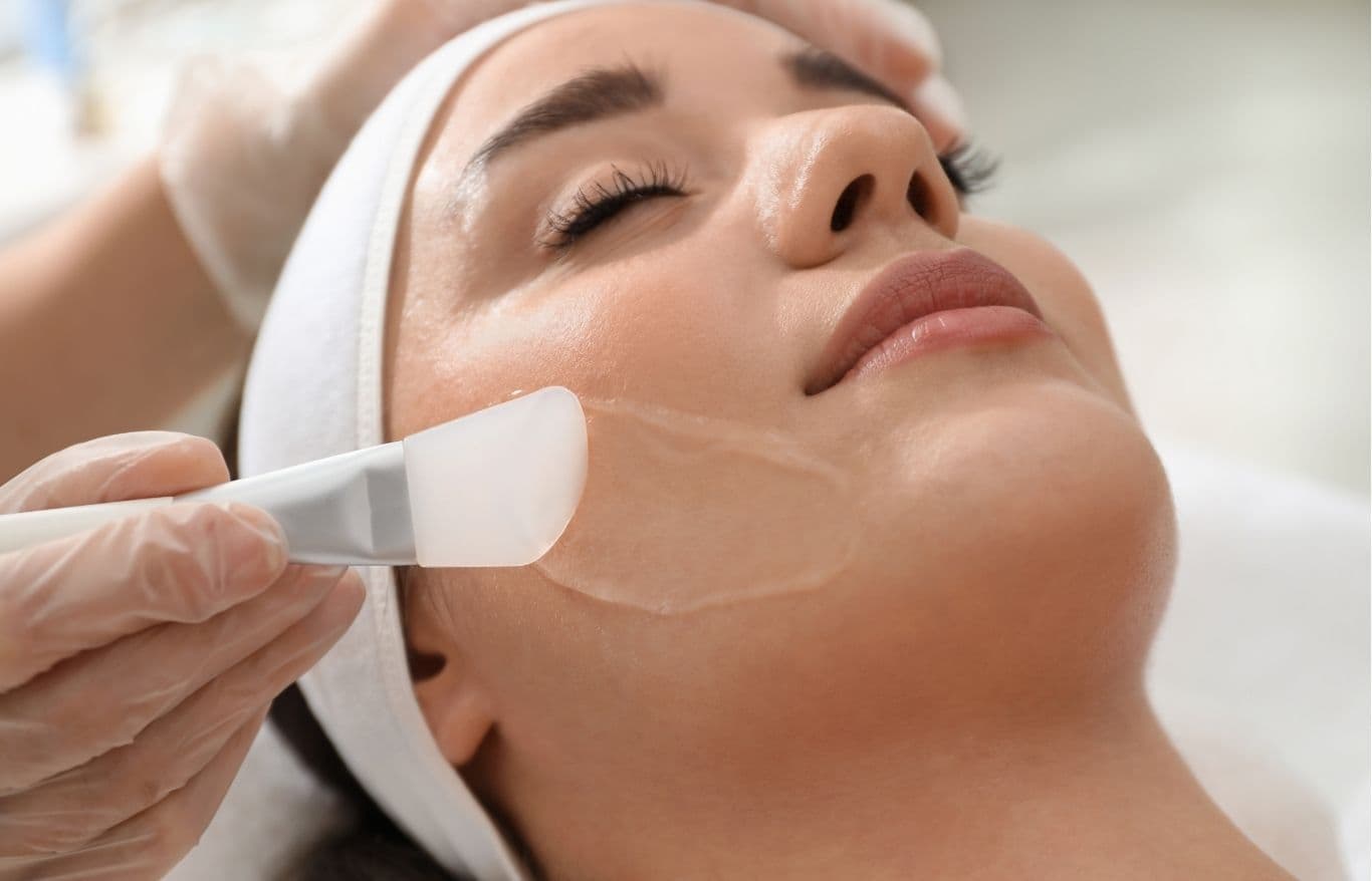 vi chemical peel